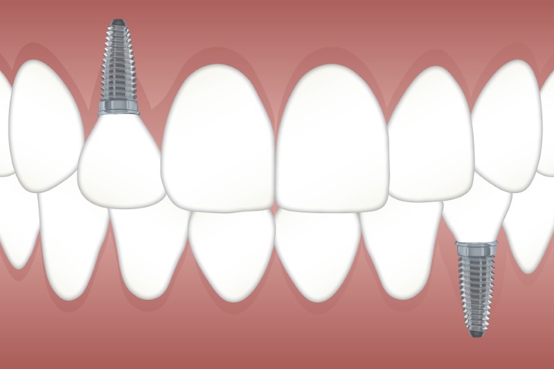 Zobni vsadki oziroma implantati
